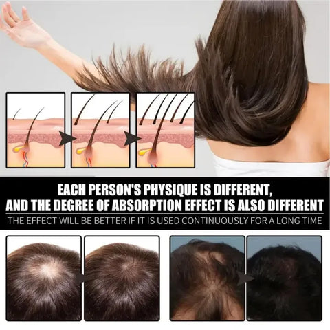 FORT Minoxidil Hair Growth Spray