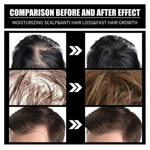 FORT Minoxidil Hair Growth Spray